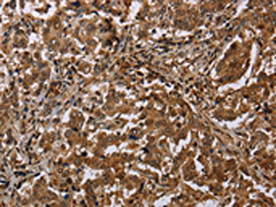 The image on the left is immunohistochemistry of paraffin-embedded Human liver cancer tissue using MFF Antibody(MFF Antibody) at dilution 1/20, on the right is treated with synthetic peptide. (Original magnification: ×200)