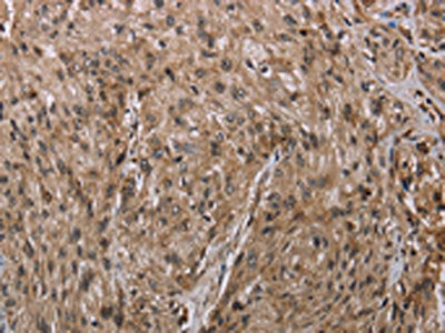 The image on the left is immunohistochemistry of paraffin-embedded Human esophagus cancer tissue using the antibody Antibody) at dilution 1/20, on the right is treated with synthetic peptide. (Original magnification: ×200)