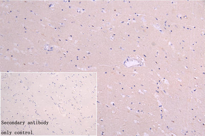 Immunohistochemistry of paraffin-embedded human glioma using IFNA2 Antibody at dilution of 1:100Rabbit anti-Human IFNA2 Polyclonal Antibody