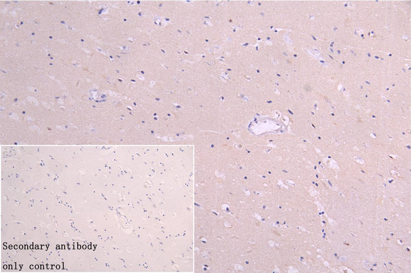 Immunohistochemistry of paraffin-embedded human glioma using IFNA2 Antibody at dilution of 1:100Rabbit anti-Human IFNA2 Polyclonal Antibody