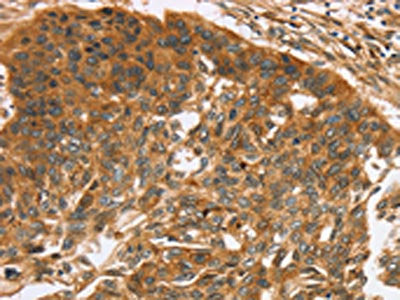 The image on the left is immunohistochemistry of paraffin-embedded Human esophagus cancer tissue using TNFSF15 Antibody(TNFSF15 Antibody) at dilution 1/40, on the right is treated with synthetic peptide. (Original magnification: ×200)Rabbit anti-Human TNFSF15 Polyclonal Antibody