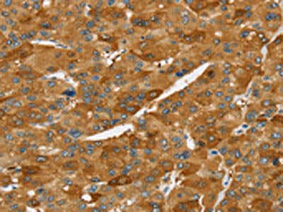 The image on the left is immunohistochemistry of paraffin-embedded Human liver cancer tissue using the antibody Antibody) at dilution 1/40, on the right is treated with synthetic peptide. (Original magnification: ×200)Rabbit anti-Human TNFSF15 Polyclonal Antibody