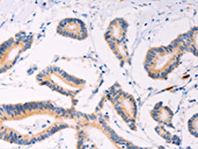 The image on the left is immunohistochemistry of paraffin-embedded Human colon cancer tissue using PLIN2 Antibody(PLIN2 Antibody) at dilution 1/20, on the right is treated with synthetic peptide. (Original magnification: ×200)Rabbit anti-Human PLIN2 Polyclonal Antibody