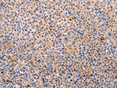 The image on the left is immunohistochemistry of paraffin-embedded Human liver cancer tissue using the antibody Antibody) at dilution 1/20, on the right is treated with synthetic peptide. (Original magnification: ×200)Rabbit anti-Human PLIN2 Polyclonal Antibody