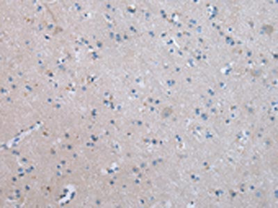 The image on the left is immunohistochemistry of paraffin-embedded Human brain tissue using COLEC12 Antibody(COLEC12 Antibody) at dilution 1/20, on the right is treated with synthetic peptide. (Original magnification: ×200)Rabbit anti-Human COLEC12 Polyclonal Antibody