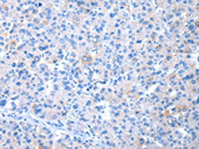 The image on the left is immunohistochemistry of paraffin-embedded Human liver cancer tissue using the antibody Antibody) at dilution 1/20, on the right is treated with synthetic peptide. (Original magnification: ×200)Rabbit anti-Human COLEC12 Polyclonal Antibody