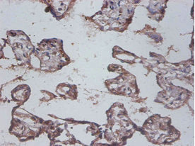 Immunohistochemistry of paraffin-embedded human colon cancer using IL12B Antibody at dilution of 1:100Rabbit anti-Human IL12B Polyclonal Antibody