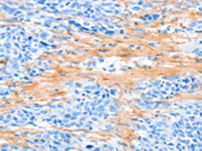The image on the left is immunohistochemistry of paraffin-embedded Human esophagus cancer tissue using AARS Antibody(AARS Antibody) at dilution 1/50, on the right is treated with synthetic peptide. (Original magnification: ×200)