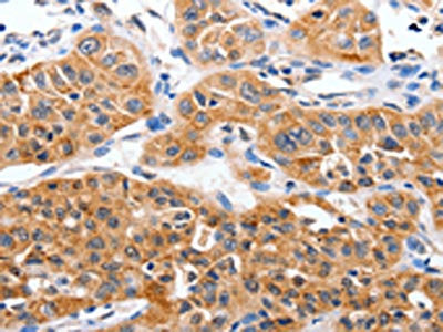 The image on the left is immunohistochemistry of paraffin-embedded Human lung cancer tissue using the antibody Antibody) at dilution 1/50, on the right is treated with synthetic peptide. (Original magnification: ×200)Rabbit anti-Human YWHAG Polyclonal Antibody