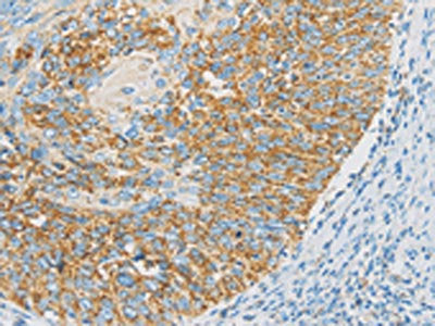The image on the left is immunohistochemistry of paraffin-embedded Human cervical cancer tissue using IDH3G Antibody(IDH3G Antibody) at dilution 1/30, on the right is treated with fusion protein. (Original magnification: ×200)Rabbit anti-Human IDH3G Polyclonal Antibody
