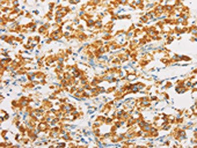The image on the left is immunohistochemistry of paraffin-embedded Human thyroid cancer tissue using the antibody Antibody) at dilution 1/30, on the right is treated with fusion protein. (Original magnification: ×200)Rabbit anti-Human IDH3G Polyclonal Antibody