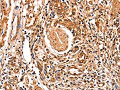 The image on the left is immunohistochemistry of paraffin-embedded Human stomach cancer tissue using FABP7 Antibody(FABP7 Antibody) at dilution 1/25, on the right is treated with fusion protein. (Original magnification: ×200)Rabbit anti-Human FABP7 Polyclonal Antibody