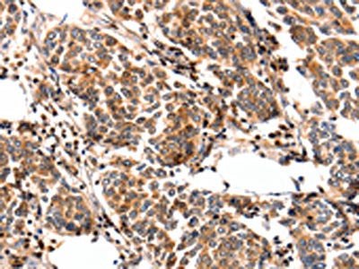 The image on the left is immunohistochemistry of paraffin-embedded Human breast cancer tissue using the antibody Antibody) at dilution 1/25, on the right is treated with fusion protein. (Original magnification: ×200)Rabbit anti-Human FABP7 Polyclonal Antibody