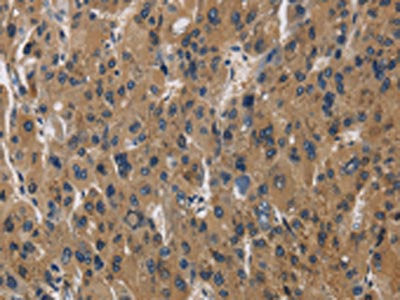 The image is immunohistochemistry of paraffin-embedded Human liver cancer tissue using AGER Antibody(AGER Antibody) at dilution 1/70. (Original magnification: ×200)Rabbit anti-Human AGER Polyclonal Antibody