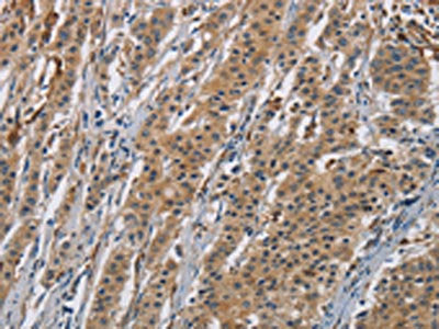 The image is immunohistochemistry of paraffin-embedded Human gastric cancer tissue using the antibody Antibody) at dilution 1/70. (Original magnification: ×200)Rabbit anti-Human AGER Polyclonal Antibody