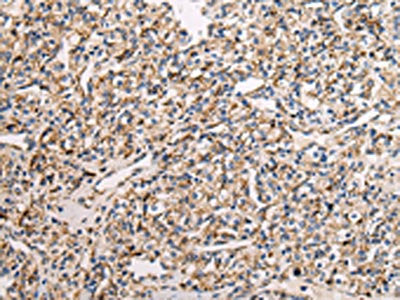 The image on the left is immunohistochemistry of paraffin-embedded Human prostate cancer tissue using UQCRC1 Antibody(UQCRC1 Antibody) at dilution 1/20, on the right is treated with fusion protein. (Original magnification: ×200)Rabbit anti-Human UQCRC1 Polyclonal Antibody