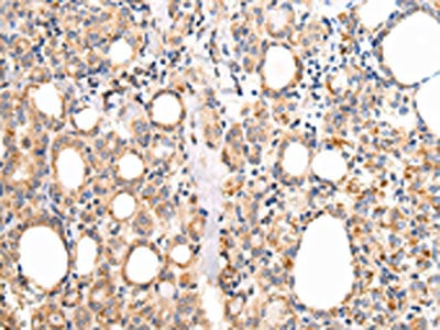 The image on the left is immunohistochemistry of paraffin-embedded Human thyroid cancer tissue using the antibody Antibody) at dilution 1/20, on the right is treated with fusion protein. (Original magnification: ×200)Rabbit anti-Human UQCRC1 Polyclonal Antibody