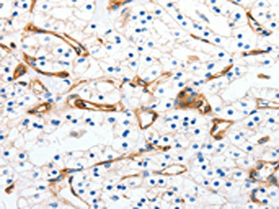 The image on the left is immunohistochemistry of paraffin-embedded Human renal cancer tissue using MCAM Antibody(MCAM Antibody) at dilution 1/50, on the right is treated with synthetic peptide. (Original magnification: ×200)