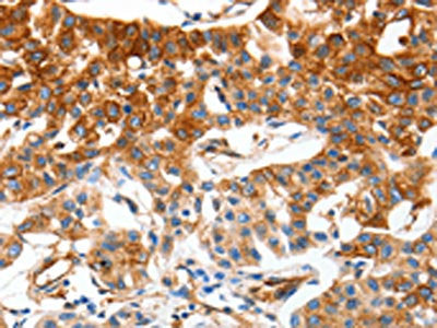 The image on the left is immunohistochemistry of paraffin-embedded Human lung cancer tissue using the antibody Antibody) at dilution 1/50, on the right is treated with synthetic peptide. (Original magnification: ×200)