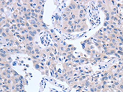 The image on the left is immunohistochemistry of paraffin-embedded Human lung cancer tissue using ACTR3B Antibody(ACTR3B Antibody) at dilution 1/15, on the right is treated with fusion protein. (Original magnification: ×200)