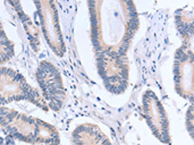 The image on the left is immunohistochemistry of paraffin-embedded Human colon cancer tissue using the antibody Antibody) at dilution 1/15, on the right is treated with fusion protein. (Original magnification: ×200)