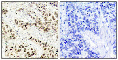 Immunohistochemical analysis of paraffin-embedded human breast carcinoma tissue using CDC2(Ab-15) Antibody(left) or the same antibody preincubated with blocking peptide(right).Rabbit anti-Human CDK1 Polyclonal Antibody