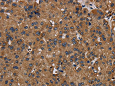 The image on the left is immunohistochemistry of paraffin-embedded Human liver cancer tissue using the antibody Antibody) at dilution 1/50, on the right is treated with fusion protein. (Original magnification: ×200)Rabbit anti-Human NDUFS8 Polyclonal Antibody