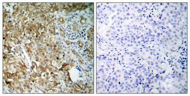 Immunohistochemical analysis of paraffin-embedded human breast carcinoma tissue using IGF-1R(Ab-1161) Antibody(left) or the same antibody preincubated with blocking peptide(right).Rabbit anti-Human IGF1R Polyclonal Antibody