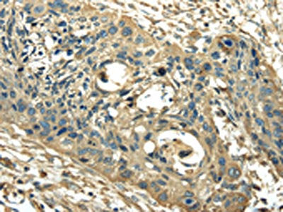 The image on the left is immunohistochemistry of paraffin-embedded Human esophagus cancer tissue using the antibody Antibody) at dilution 1/25, on the right is treated with synthetic peptide. (Original magnification: ×200)Rabbit anti-Human PKM Polyclonal Antibody