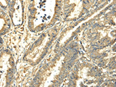 The image on the left is immunohistochemistry of paraffin-embedded Human esophagus cancer tissue using TUBA1C Antibody(TUBA1C Antibody) at dilution 1/25, on the right is treated with fusion protein. (Original magnification: ×200)Rabbit anti-Human TUBA1C Polyclonal Antibody
