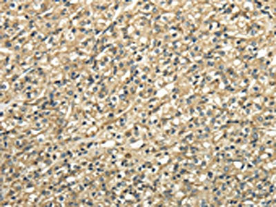 The image on the left is immunohistochemistry of paraffin-embedded Human prostate cancer tissue using the antibody Antibody) at dilution 1/25, on the right is treated with fusion protein. (Original magnification: ×200)Rabbit anti-Human TUBA1C Polyclonal Antibody