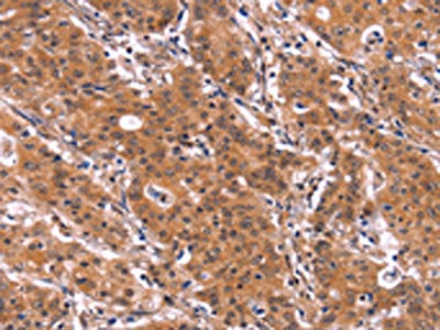 The image on the left is immunohistochemistry of paraffin-embedded Human gastric cancer tissue using ARL4A Antibody(ARL4A Antibody) at dilution 1/60, on the right is treated with fusion protein. (Original magnification: ×200)Rabbit anti-Human ARL4A Polyclonal Antibody