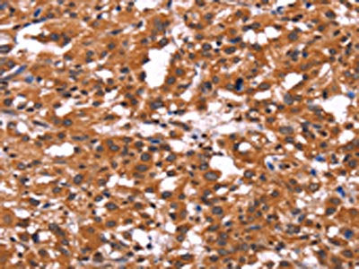 The image on the left is immunohistochemistry of paraffin-embedded Human thyroid cancer tissue using the antibody Antibody) at dilution 1/60, on the right is treated with fusion protein. (Original magnification: ×200)Rabbit anti-Human ARL4A Polyclonal Antibody