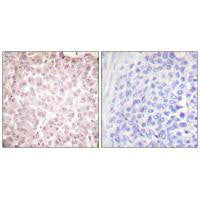 Immunohistochemical analysis of paraffin-embedded human breast carcinoma tissue using RCC1 antibody.Rabbit anti-Human RCC1 Polyclonal Antibody