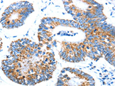 The image on the left is immunohistochemistry of paraffin-embedded Human colon cancer tissue using AIFM1 Antibody(AIFM1 Antibody) at dilution 1/30, on the right is treated with fusion protein. (Original magnification: ×200)Rabbit anti-Human AIFM1 Polyclonal Antibody