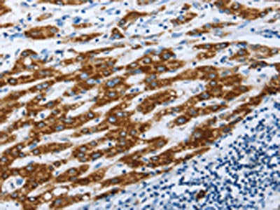 The image on the left is immunohistochemistry of paraffin-embedded Human liver cancer tissue using the antibody Antibody) at dilution 1/30, on the right is treated with fusion protein. (Original magnification: ×200)Rabbit anti-Human AIFM1 Polyclonal Antibody