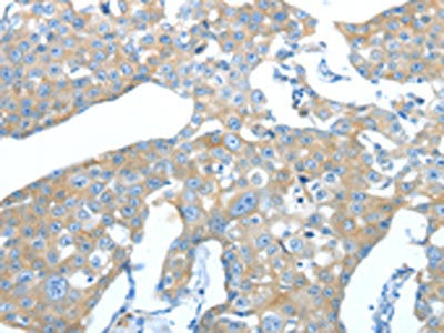 The image on the left is immunohistochemistry of paraffin-embedded Human breast cancer tissue using AMPH Antibody(AMPH Antibody) at dilution 1/25, on the right is treated with fusion protein. (Original magnification: ×200)Rabbit anti-Human AMPH Polyclonal Antibody