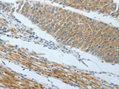 The image on the left is immunohistochemistry of paraffin-embedded Human liver cancer tissue using the antibody Antibody) at dilution 1/25, on the right is treated with fusion protein. (Original magnification: ×200)Rabbit anti-Human AMPH Polyclonal Antibody