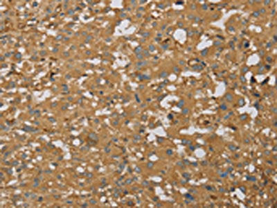 The image on the left is immunohistochemistry of paraffin-embedded Human thyroid cancer tissue using the antibody Antibody) at dilution 1/60, on the right is treated with fusion protein. (Original magnification: ×200)Rabbit anti-Human AHSG Polyclonal Antibody