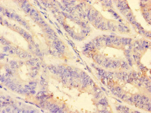 Immunohistochemistry of paraffin-embedded human endometrial cancer using the antibody at dilution of 1:100Rabbit anti-Human MMP2 Polyclonal Antibody