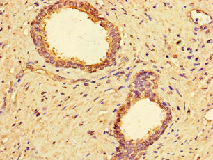 Immunohistochemistry of paraffin-embedded human prostate cancer using MMP2 Antibody at dilution of 1:100Rabbit anti-Human MMP2 Polyclonal Antibody