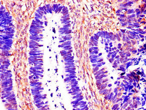 Immunohistochemistry of paraffin-embedded human ovarian cancer using CTSB Antibody at dilution of 1:100Rabbit anti-Human CTSB Polyclonal Antibody