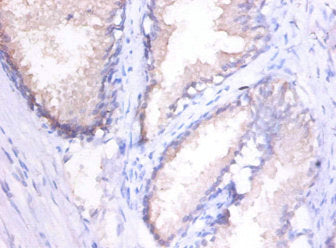 Immunohistochemistry of paraffin-embedded human spleen tissue using MMP1 Antibody at dilution of 1:100Rabbit anti-Human MMP1 Polyclonal Antibody