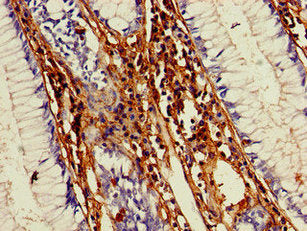 Immunohistochemistry of paraffin-embedded human colon cancer using MMP13 Antibody at dilution of 1:100Rabbit anti-Human MMP13 Polyclonal Antibody