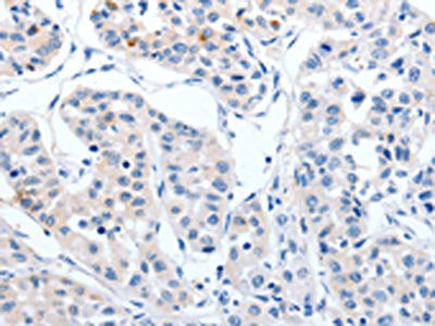 The image on the left is immunohistochemistry of paraffin-embedded Human lung cancer tissue using RBFOX3 Antibody(RBFOX3 Antibody) at dilution 1/25, on the right is treated with synthetic peptide. (Original magnification: ×200)Rabbit anti-Human RBFOX3 Polyclonal Antibody