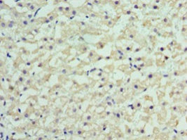 Immunohistochemistry of paraffin-embedded human liver cancer using RBP4 Antibody at dilution of 1:100Rabbit anti-Human RBP4 Polyclonal Antibody