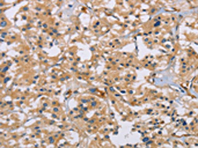 The image on the left is immunohistochemistry of paraffin-embedded Human thyroid cancer tissue using ACTN4 Antibody(ACTN4 Antibody) at dilution 1/60, on the right is treated with fusion protein. (Original magnification: X200)