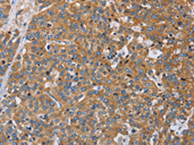 The image on the left is immunohistochemistry of paraffin-embedded Human esophagus cancer tissue using the antibody Antibody) at dilution 1/60, on the right is treated with fusion protein. (Original magnification: X200)