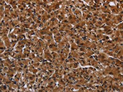 The image on the left is immunohistochemistry of paraffin-embedded Human prostate cancer tissue using IRGM Antibody(IRGM Antibody) at dilution 1/60, on the right is treated with fusion protein. (Original magnification: ×200)
