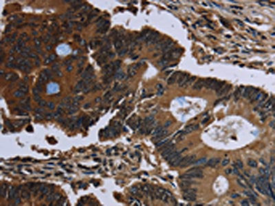 The image on the left is immunohistochemistry of paraffin-embedded Human colon cancer tissue using the antibody Antibody) at dilution 1/60, on the right is treated with fusion protein. (Original magnification: ×200)